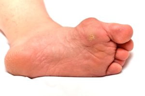 corns on a foot closeup