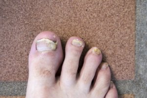 Fungal toenail infection in athlete's foot
