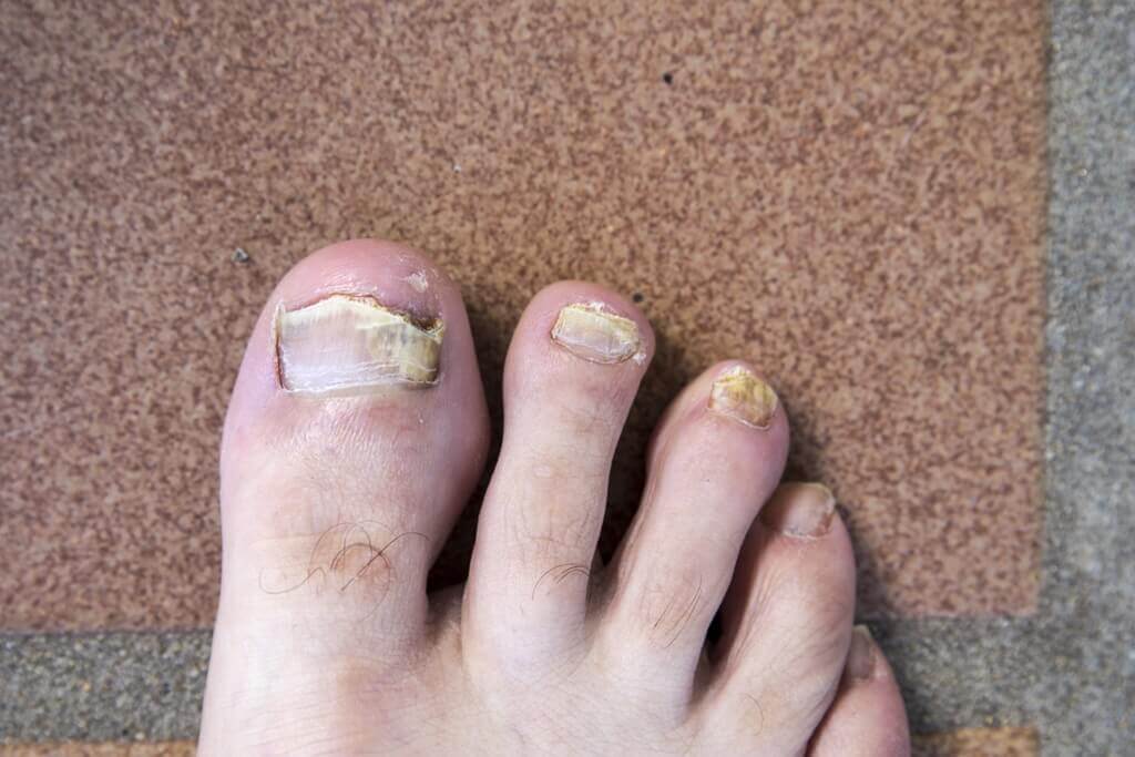 Tinea Pedis How To Get Rid Of Fungus Between Toes