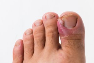 ingrown toenail closeup , podiatry ingrown toenail