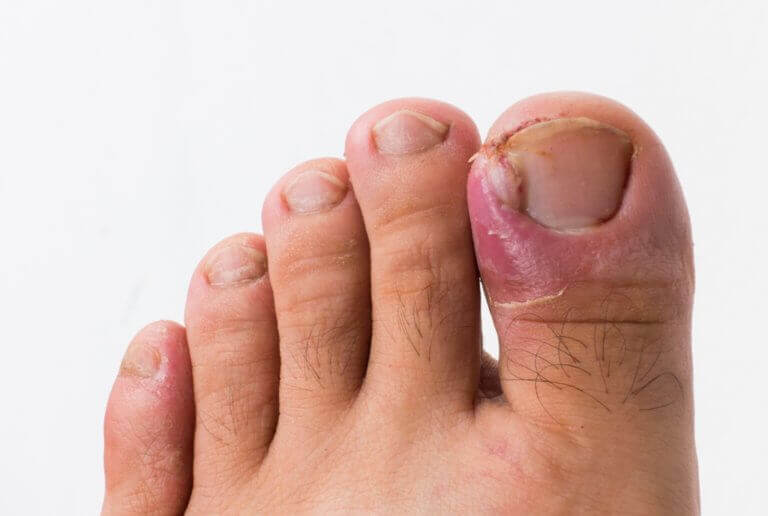 Ingrown Toenail Round House Podiatry