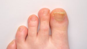 Thickened toenails closeup