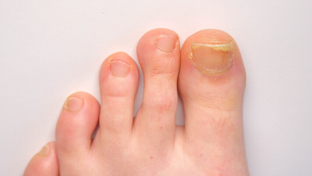A nail ready for toenail reconstruction , toenail reconstruction