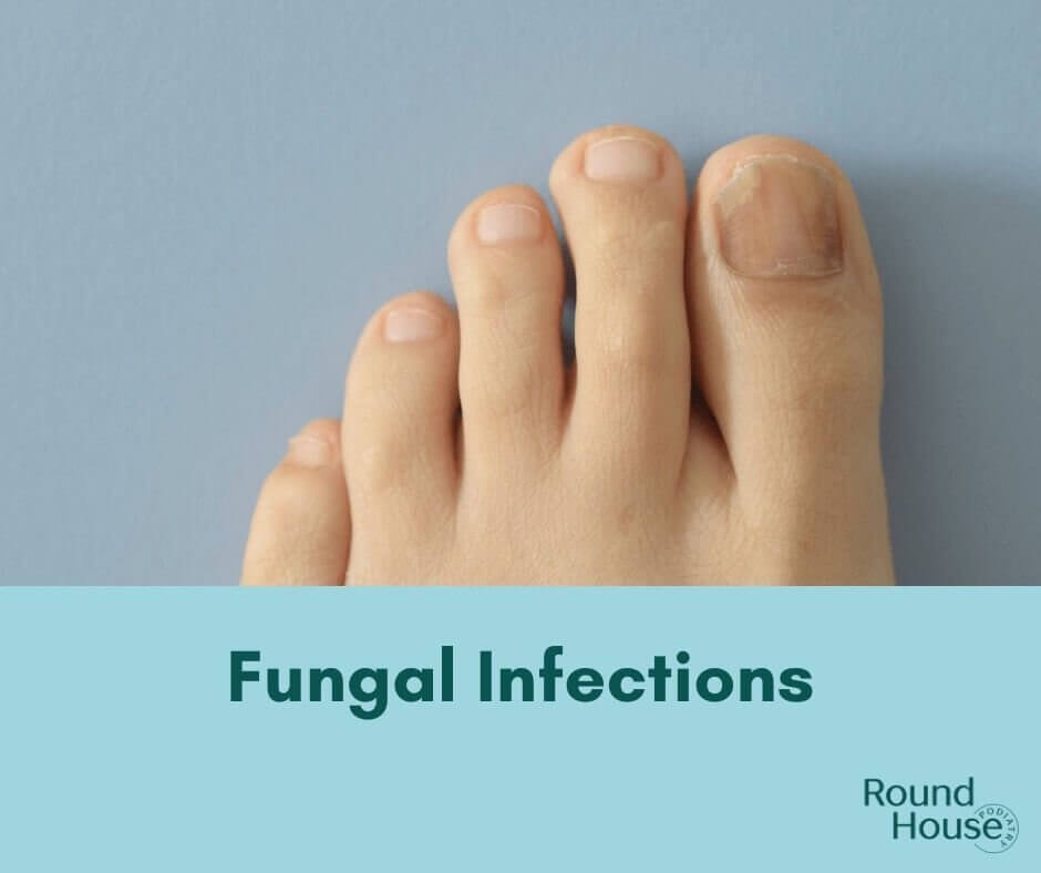 Fungal Infections and Feet