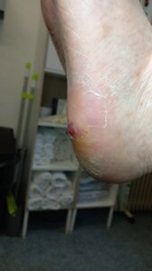 Wound in back of foot