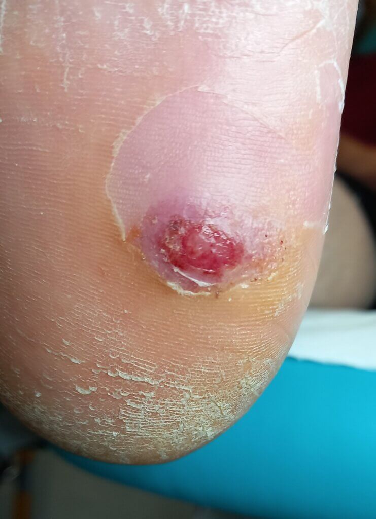 wound in the skin of foot