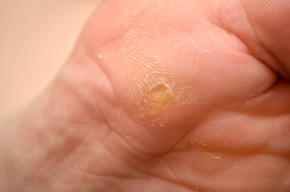 Best way to get rid of corns 2024 and calluses