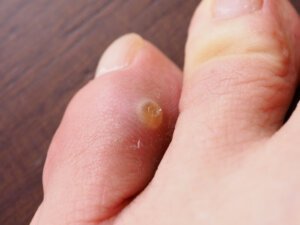 Getting rid of a cheap corn on your toe