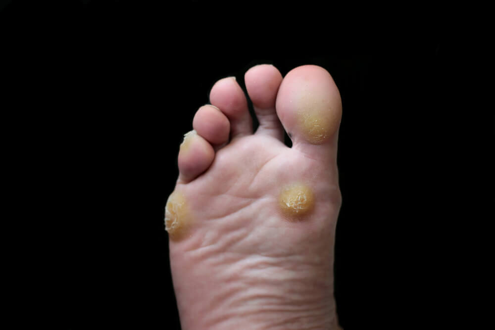 Callus removal from feet: balls of feet 