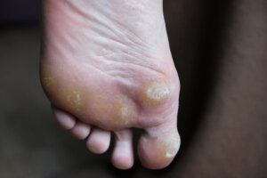 Callus on the foot Round House Podiatry