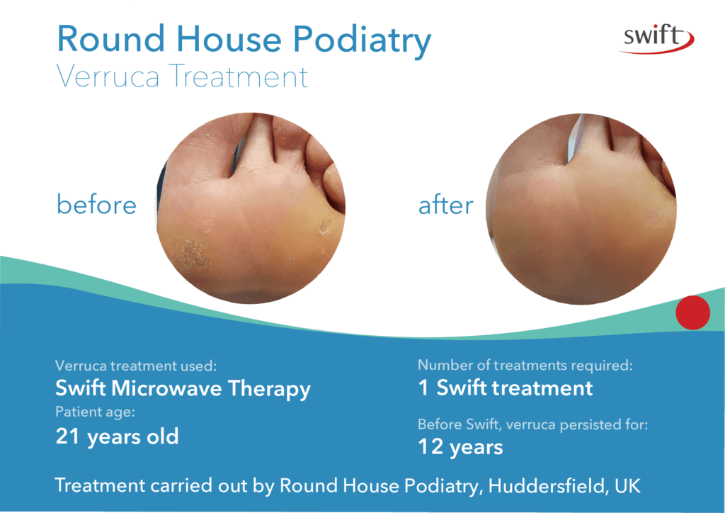 a case study of a Swift Microwave Verruca treatment at Round House Podiatry