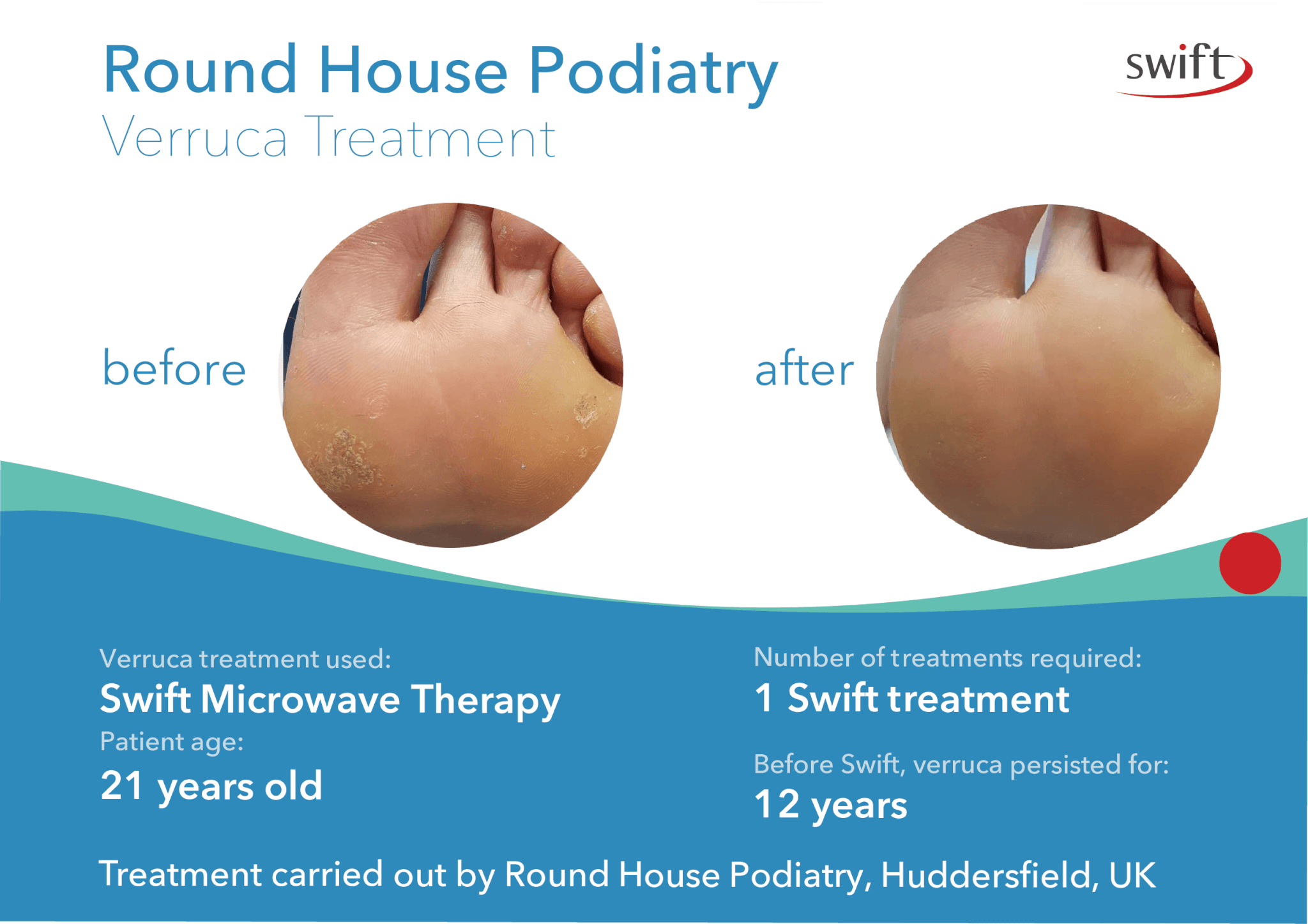 How-long-does-it-take-to-get-rid-of-a-verruca-Round-House-Podiatry-Huddersfield-Verruca-case-study.png