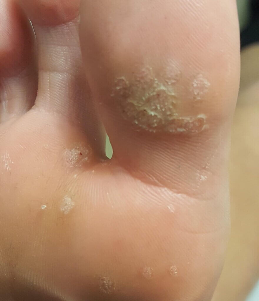 help with a verruca on the big toe