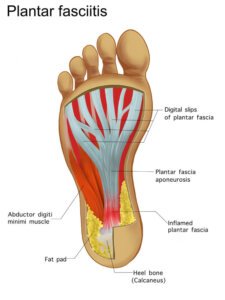 Plantar Fasciitis, Heel Pain