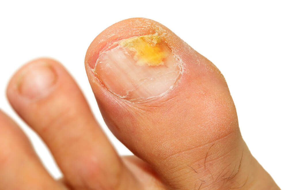 toenail ready for treatment for fungal nail infection