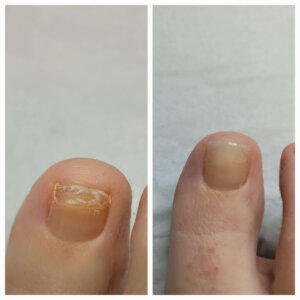 recent cosmetic toenail reconstruction