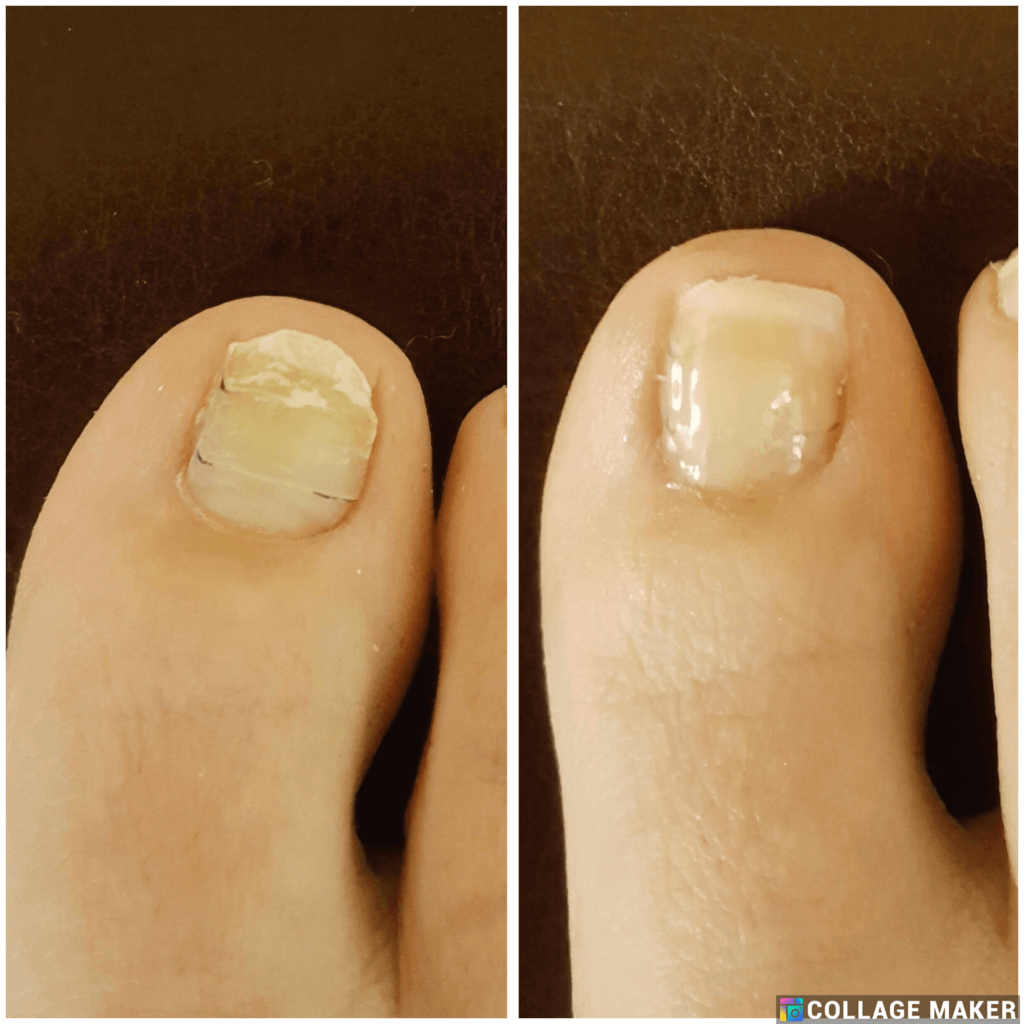 Cosmetic toenail reconstruction