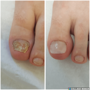 reconstructed fungal nail