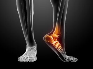 Rheumatoid Arthritis In Feet