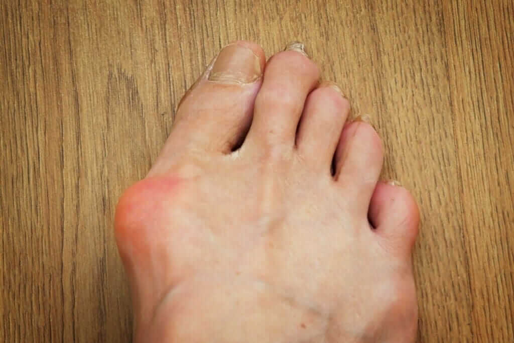 A foot with a bunion