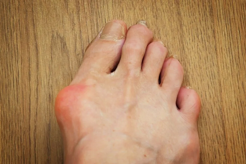 A foot with a bunion