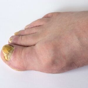 how to treat a fungal nail infection