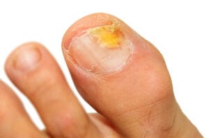 Fungal nail infection