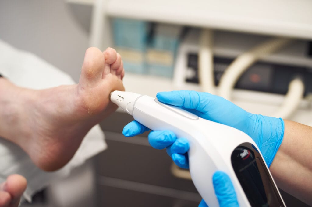 Swift verruca treatment - effective verruca treatment