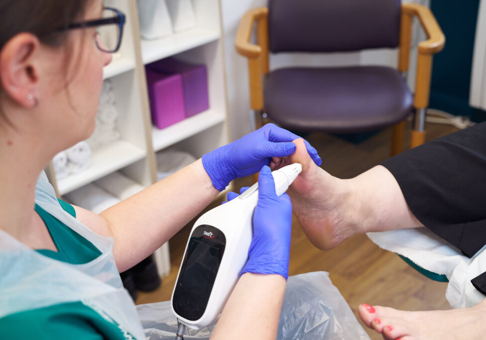 Round House Podiatry Huddersfield - Swift Verruca Treatment Swift verruca treatment at Round House Podiatry, Huddersfield