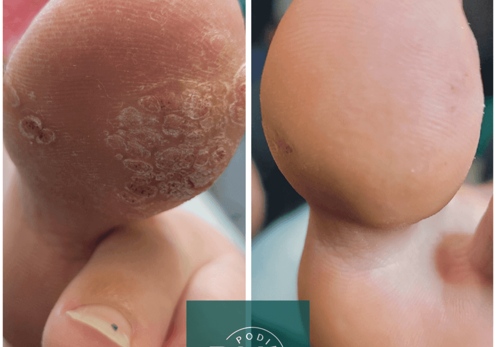 large verruca before and after microwave treatment