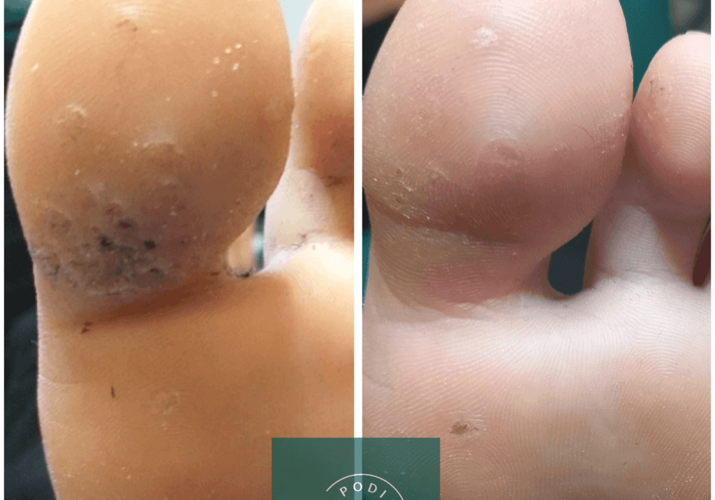verruca on the toe before and after treatment with Swift